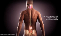 ReActiv8 est un dispositif implantable de neurostimulation des muscles du bas de la colonne vertébrale. (crédit : Mainstay Medical)