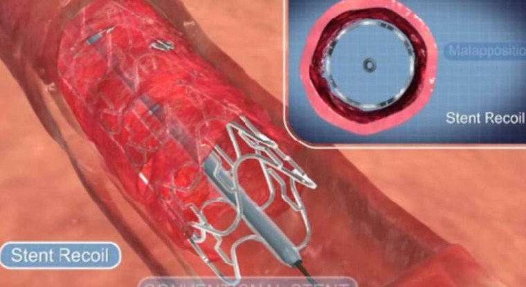 La montée en puissance de la nouvelle génération de stents se fait attendre. (© Stentys)