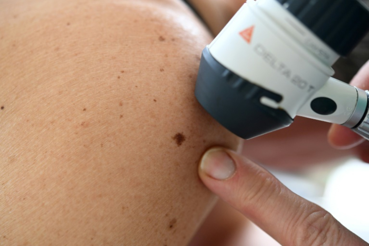Une dermatologue examine un grain de beauté sur une patiente, le 22 mai 2019 à Quimper ( AFP / Fred TANNEAU )