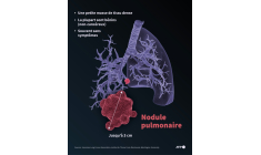 Caractéristiques générales d'un nodule pulmonaire, une petite masse dans le poumon, que le pape Léon XIV doit se faire retirer lors d'une intervention chirurgicale ( AFP / Jonathan WALTER )