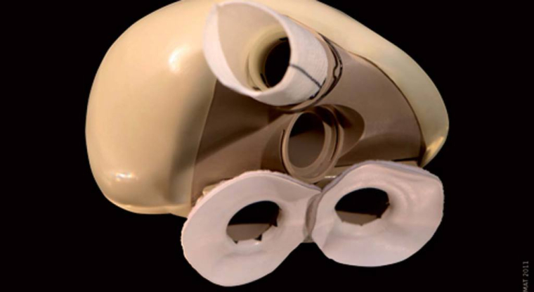 La prothèse de cœur intégrale Carmat. (© Carmat)