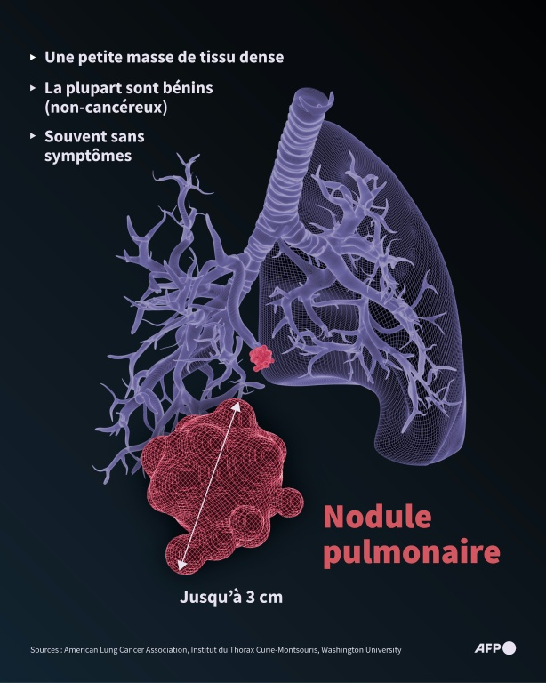 Caractéristiques générales d'un nodule pulmonaire, une petite masse dans le poumon généralement bénigne, que le pape Léon XIV doit se faire retirer lors d'une intervention chirurgicale ( AFP / Jonathan WALTER )