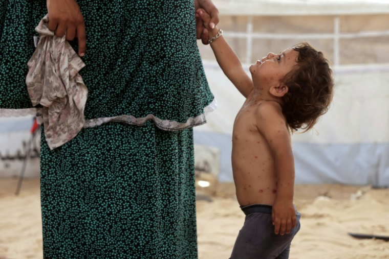 Rouba, une petite Palestinienne souffrant de la varicelle, selon les médecins, dans la tente familiale dans le camp de Khan Younes, à Gaza, le 19 juillet 2026 ( AFP / Bashar Taleb )