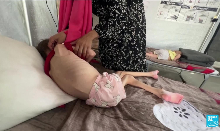 Gaza : les enfants face à la malnutrition