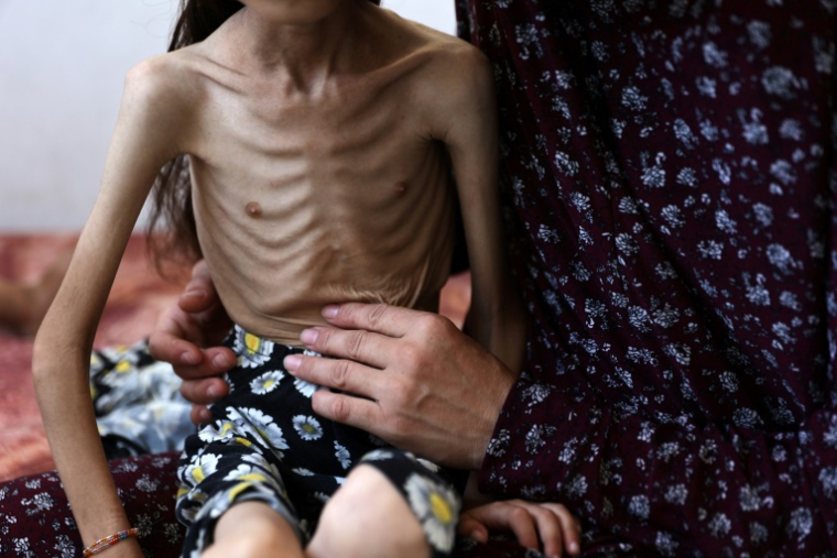 Une fillette souffrant de malnutrition sur les genoux de sa mère, le 2 août 2025 à Gaza ( AFP / Omar AL-QATTAA )