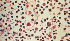 Photo non datée fournie par les Centres américains de contrôle et de prévention des maladies (CDC), le 6 mai 2026, montrant au microscope certains détails histopathologiques d'un prélèvement de ganglion lymphatique effectué chez un patient suspecté d'être atteint d'une infection à hantavirus ( US Centers for Disease Control and Prevention (CDC) / HANDOUT )