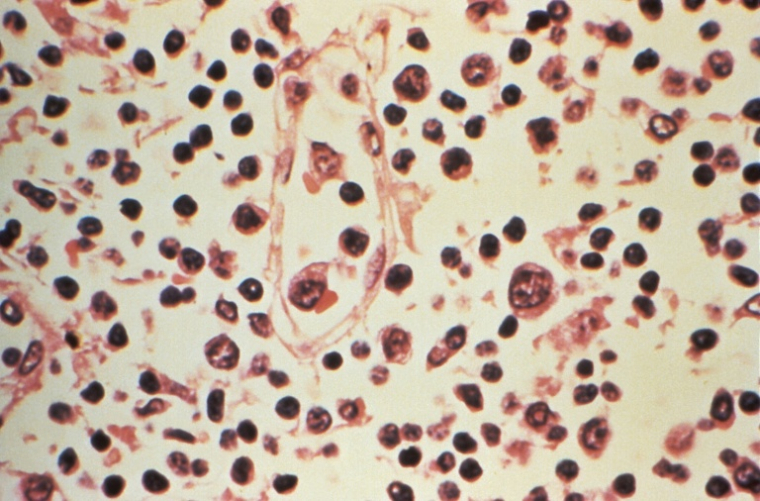 Photo non datée fournie par les Centres américains de contrôle et de prévention des maladies (CDC), le 6 mai 2026, montrant au microscope certains détails histopathologiques d'un prélèvement de ganglion lymphatique effectué chez un patient suspecté d'être atteint d'une infection à hantavirus ( US Centers for Disease Control and Prevention (CDC) / HANDOUT )