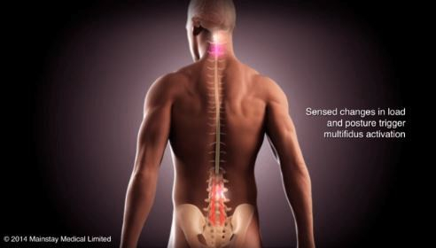 ReActiv8 est un dispositif implantable de neurostimulation des muscles du bas de la colonne vertébrale. (crédit : Mainstay Medical)