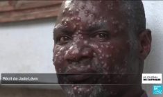 Mpox : l'agence de santé de l'Union africaine déclare "une urgence de santé publique"