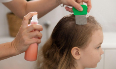 Il existe des alternatives aux shampoings toxiques pour se débarrasser des poux. ( crédit photo : Shutterstock )