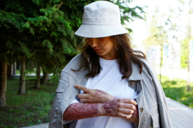 Zarina Guiyassova, survivante de l'explosion de gaz survenue dans un restaurant de Chtchoutchinsk, lors d'un entretien avec l'AFP, le 27 mai 2026 au Kazakhstan ( AFP / Ruslan PRYANIKOV )