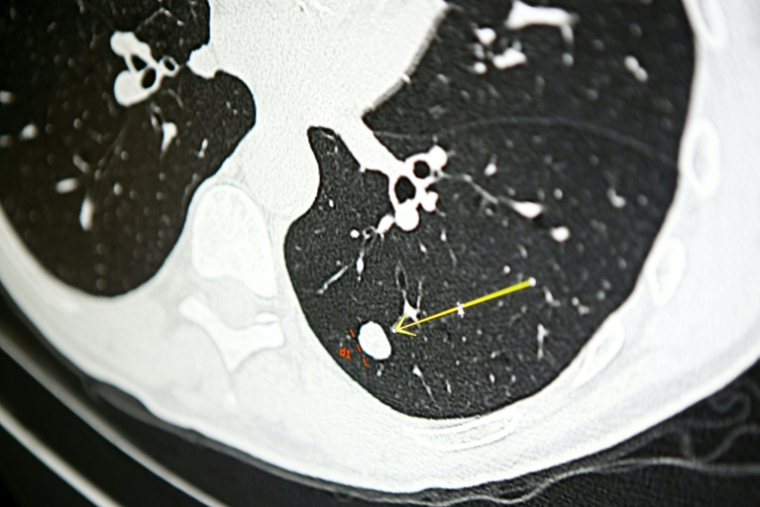 Un nodule sur le scanner pulmonaire d'une personne fumeuse, le 16 décembre 2021 à Ajaccio, en Corse-du-Sud ( AFP / Pascal POCHARD-CASABIANCA )