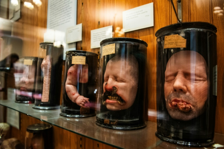 Des moulages en cire de patients souffrant de diverses maladies de la peau et du visage au Mütter Museum, à Philadelphie, le 20 août 2025 en Pennsylvanie ( AFP / Matthew Hatcher )