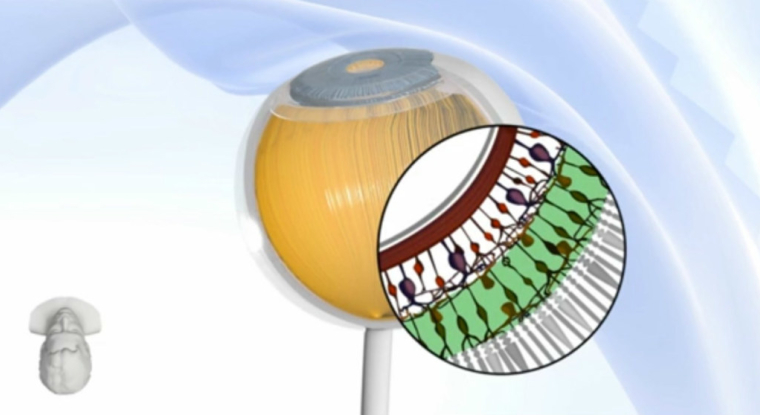 La medtech est parvenue à activer son implant sous-rétinien, Prima, chez un patient atteint de la forme atrophique sèche de la DMLA. (© Pixium Vision)