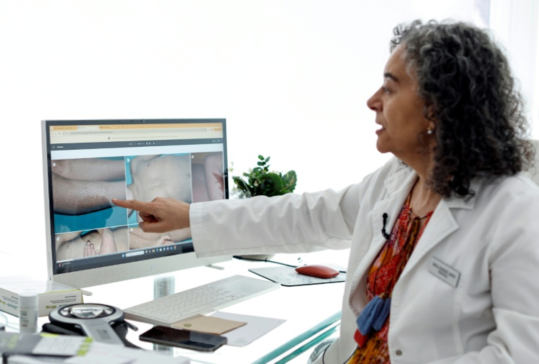 La dermatologue Angela Hernandez, spécialiste de l'ichtyose, une maladie génétique de la peau qui empêche les patients de transpirer correctement en cas de chaleur extrême, montre des images sur son ordinateur lors d'un entretien avec l'AFP à Madrid, le 8 juillet 2026 ( AFP / OSCAR DEL POZO )