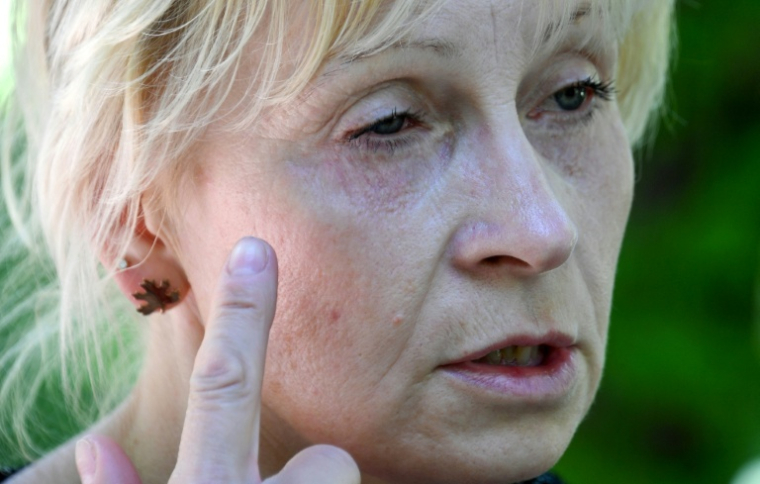 Oksana Tikhaïa, victime d'une opération ratée de chirurgie esthétique, montre son oeil à Bichkek, le 15 mai 2026 au Kirghizstan ( AFP / Vyacheslav OSELEDKO )