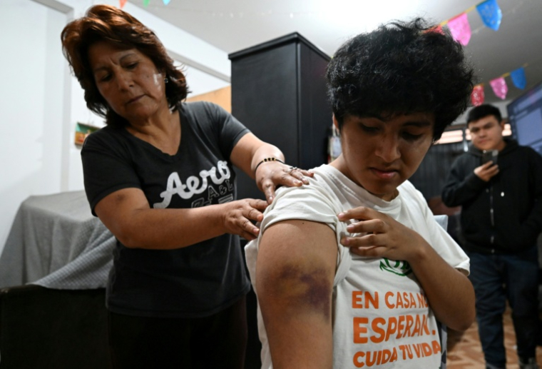 L'étudiant Angelo Nael Genti, blessé lors des manifestations du mouvement Génération Z le 15 octobre à Lima, montre ses blessures lors d'une interview avec l'AFP à son domicile à Ventanilla, au Pérou, le 19 octobre 2025 ( AFP / Raul ARBOLEDA )