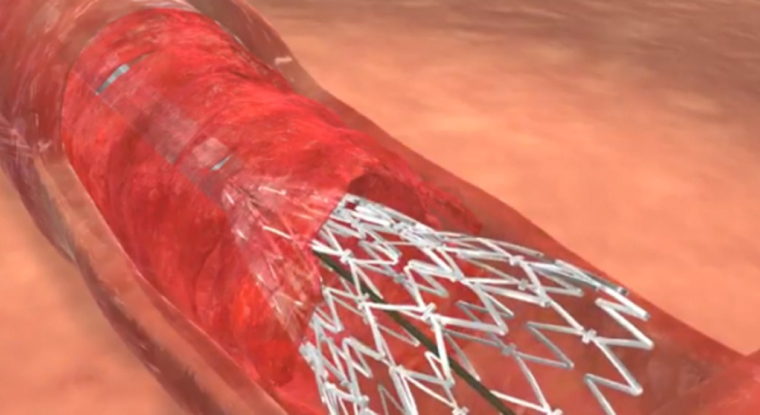 Un stent Stentys. (© Stentys)