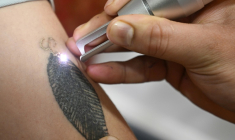 Une personne se fait retirer un tatouage au laser dans une clinique de Srinagar, au Cachemir indien, le 22 avril 2025 ( AFP / Tauseef MUSTAFA )
