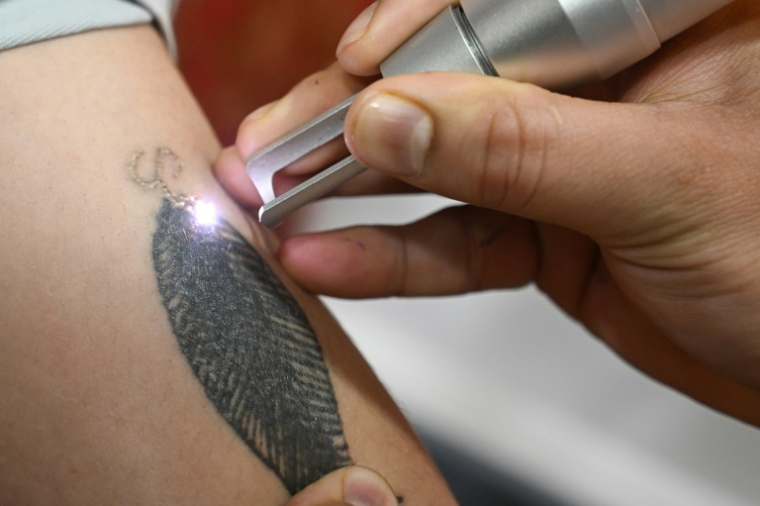 Une personne se fait retirer un tatouage au laser dans une clinique de Srinagar, au Cachemir indien, le 22 avril 2025 ( AFP / Tauseef MUSTAFA )