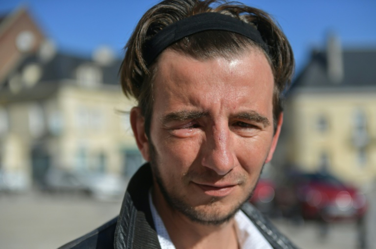 Alexandre Frey, l'une des 23 personnes éborgnées par les forces de l'ordre lors du mouvement de l'hiver 2018-2019, le 26 février 2019 à Breteuil, dans l'Eure  ( AFP / PHILIPPE HUGUEN )