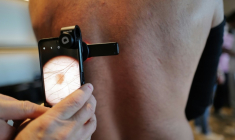 Un kiné utilise un smartphone et un dermascope pour repérer des mélanomes, le 26 septembre 2026, à Montpellier dans l'Hérault ( AFP / Sylvain THOMAS )