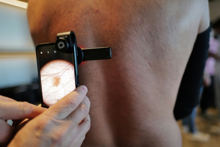 Un kiné utilise un smartphone et un dermascope pour repérer des mélanomes, le 26 septembre 2026, à Montpellier dans l'Hérault ( AFP / Sylvain THOMAS )