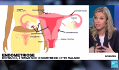 L'endométriose : une maladie méconnue qui touche 10 % des femmes