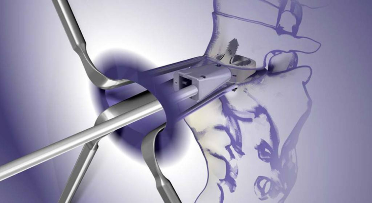 Un implant LDR pour la colonne vertébrale. (© LDR)