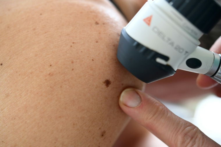 Une dermatologue examine un grain de beauté sur une patiente, le 22 mai 2019 à Quimper ( AFP / Fred TANNEAU )