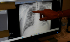 Lisa Emery, directrice du Breathing Center and Black Lung Clinic at New River Health, montre une radiographie des poumons d'un mineur de charbon souffrant de pneumoconiose, le 13 août 2026 à Oak Hill, en Virginie-Occidentale (Etats-Unis) ( AFP / Pierre HARDY )