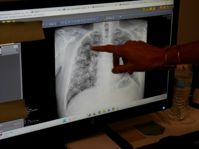 Lisa Emery, directrice du Breathing Center and Black Lung Clinic at New River Health, montre une radiographie des poumons d'un mineur de charbon souffrant de pneumoconiose, le 13 août 2026 à Oak Hill, en Virginie-Occidentale (Etats-Unis) ( AFP / Pierre HARDY )