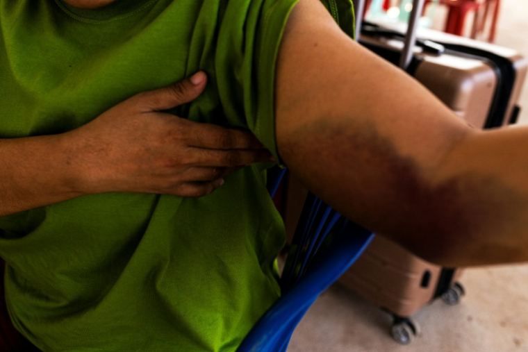 Une victime présumée d'un centre cyber-arnaque en Birmanie montre des traces de coups, après sa libération, avant de traverser la frontière avec la Thaïlande, à Myawaddy, le 12 février 2025 ( AFP / STR )