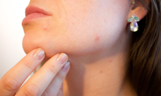 Les patchs anti-boutons sont en train de devenir un véritable accessoire de mode. (illustration) (Pixabay / Kjerstin_Michaela)